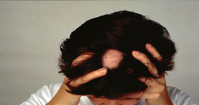 Caduta dei capelli: diagnosi, cause e rimedi - Articoli & News - Farmabeauty